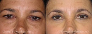 Patient 1a Eyelid Surgery Before and After