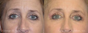 Patient 2a Eyelid Surgery Before and After