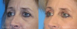 Patient 2b Eyelid Surgery Before and After