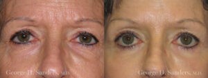 Patient 3a Eyelid Surgery Before and After