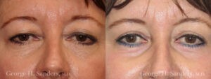 Patient 4a Eyelid Surgery Before and After