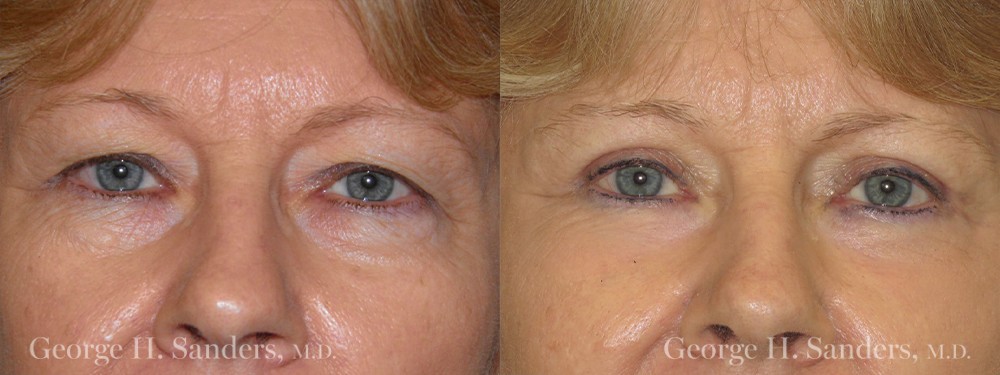 Patient 5a Eyelid Surgery Before and After