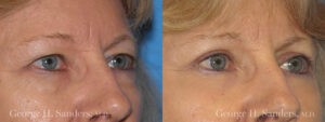Patient 5b Eyelid Surgery Before and After