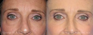 Patient 7a Eyelid Surgery Before and After
