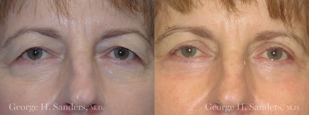 Patient 8a Eyelid Surgery Before and After