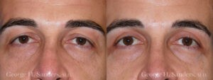 Patient 2a Male Eyelid surgery