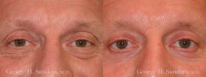 Patient 4a Male Eyelid surgery