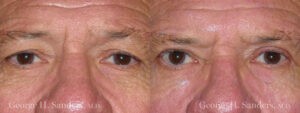 Patient 7a Male Eyelid surgery