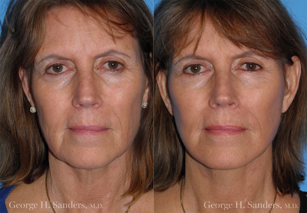 Patient 1a Face Lift Before and After