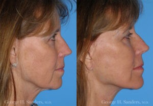 Patient 1b Face Lift Before and After