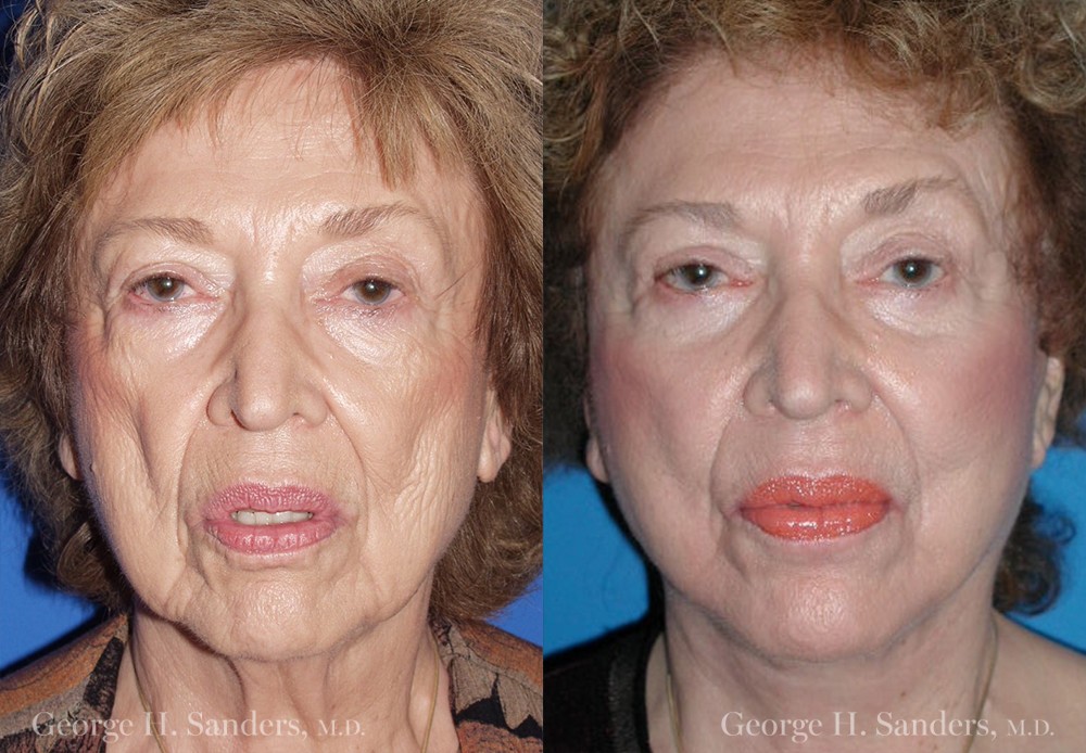 Patient 3a Face Lift Before and After
