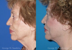Patient 3b Face Lift Before and After