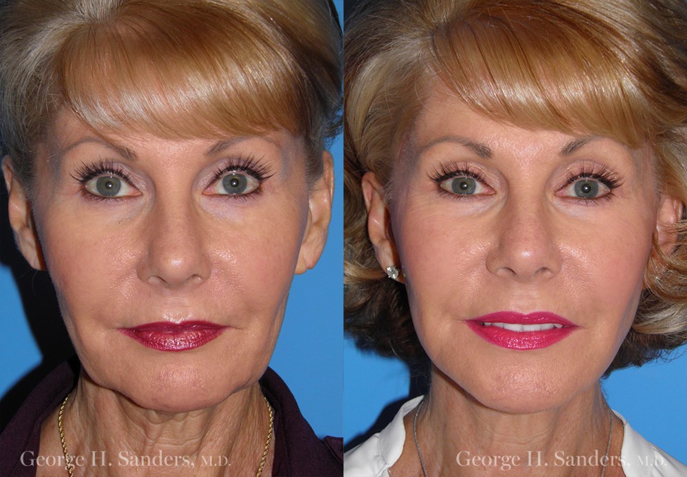 Patient 4a Face Lift Before and After