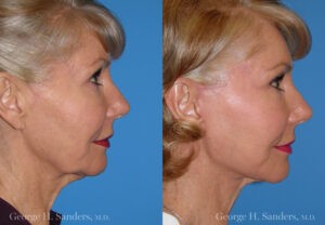 Patient 4b Face Lift Before and After