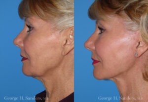 Patient 4c Face Lift Before and After