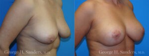 Patient 1b Breast Lift Before and After