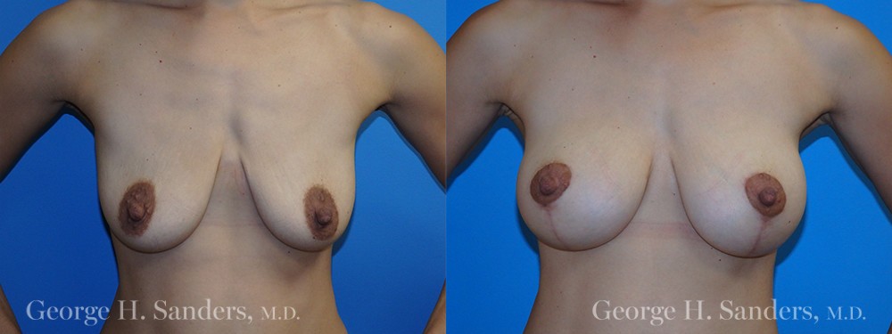 Patient 2a Breast Lift Before and After