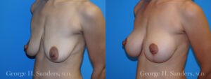Patient 2b Breast Lift Before and After