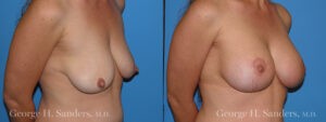 Patient 3b Breast Lift Before and After