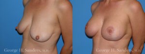 Patient 3c Breast Lift Before and After