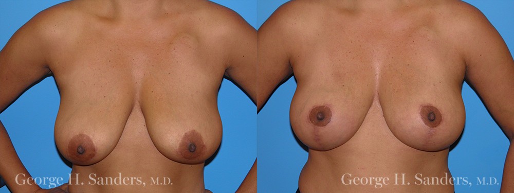 Patient 4a Breast Lift Before and After