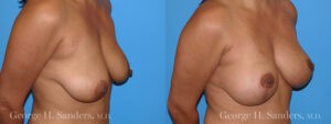 Patient 4b Breast Lift Before and After