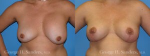 Patient 5a Breast Lift Before and After