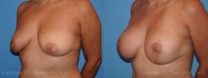 dr-sanders-los-angeles-breast-augmentation-Patient-28-3