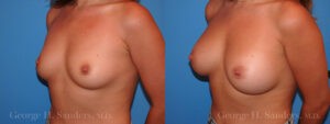 dr-sanders-los-angeles-breast-augmentation_Patient-31-1