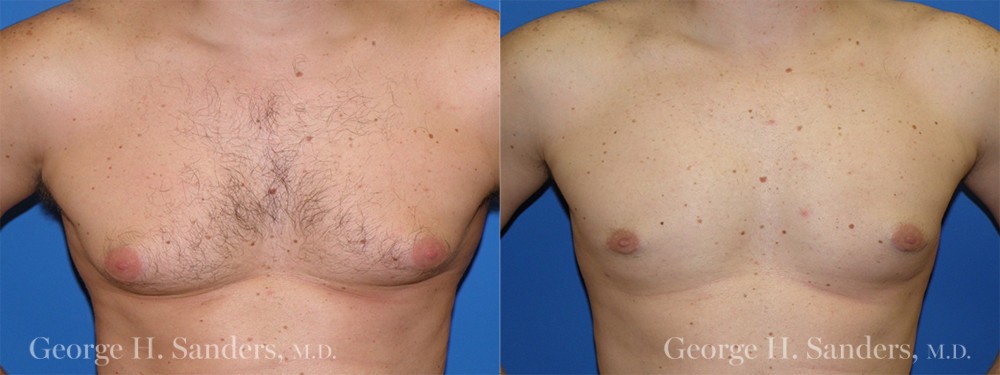 Patient 1a Gynecomastia Before and After