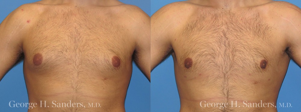 Patient 11a Gynecomastia Before and After