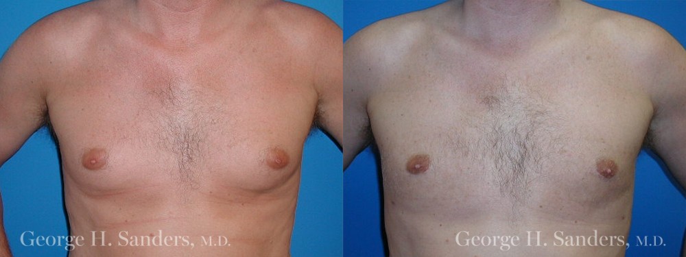 Patient 4a Gynecomastia Before and After