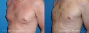 Patient 4b Gynecomastia Before and After