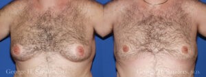 Patient 5a Gynecomastia Before and After
