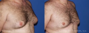 Patient 5b Gynecomastia Before and After