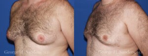 Patient 5c Gynecomastia Before and After