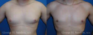 Patient 6a Gynecomastia Before and After