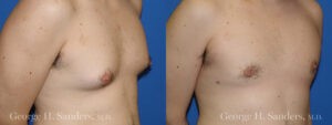 Patient 7b Gynecomastia Before and After