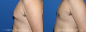 Patient 7c Gynecomastia Before and After
