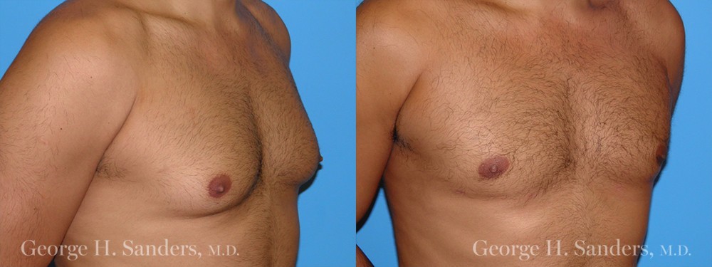 Patient 9a Gynecomastia Before and After