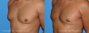 Patient 9b Gynecomastia Before and After