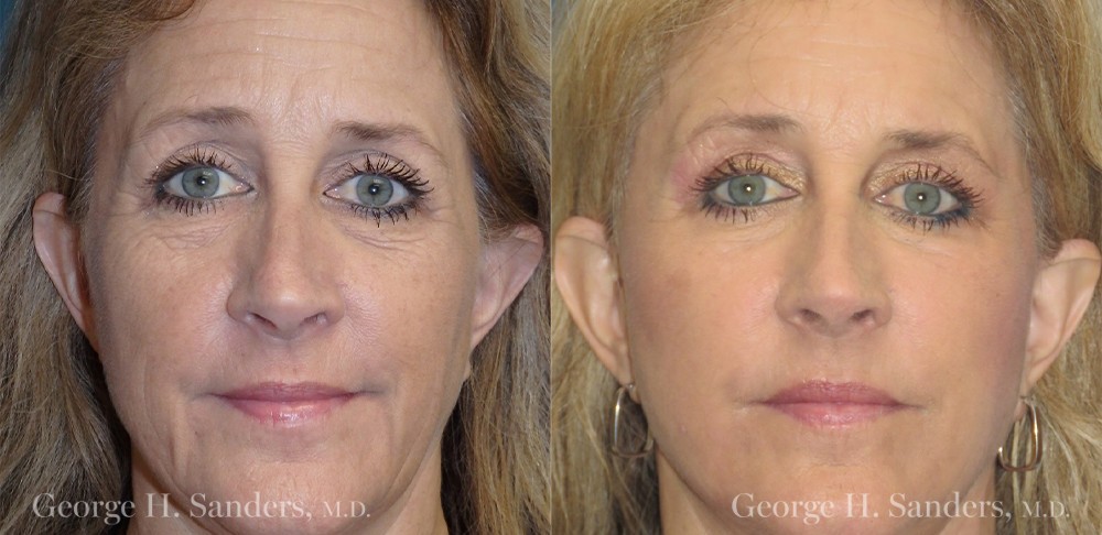 Patient 1a Laserbrasion Before and After