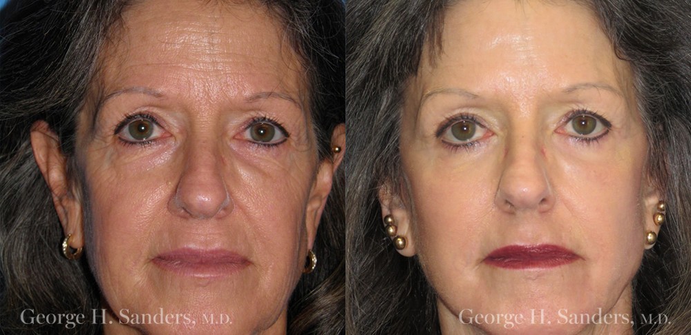 Patient 10a Laserbrasion Before and After