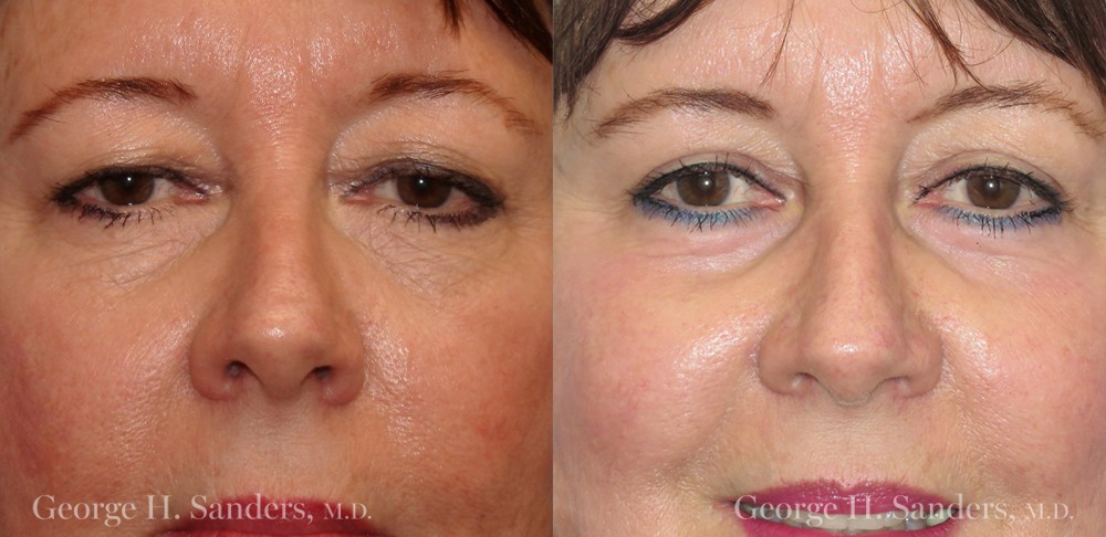 Patient 2a Laserbrasion Before and After