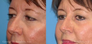 Patient 2b Laserbrasion Before and After