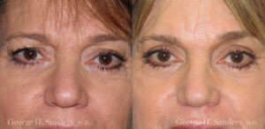 Patient 3a Laserbrasion Before and After