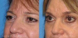 Patient 3b Laserbrasion Before and After