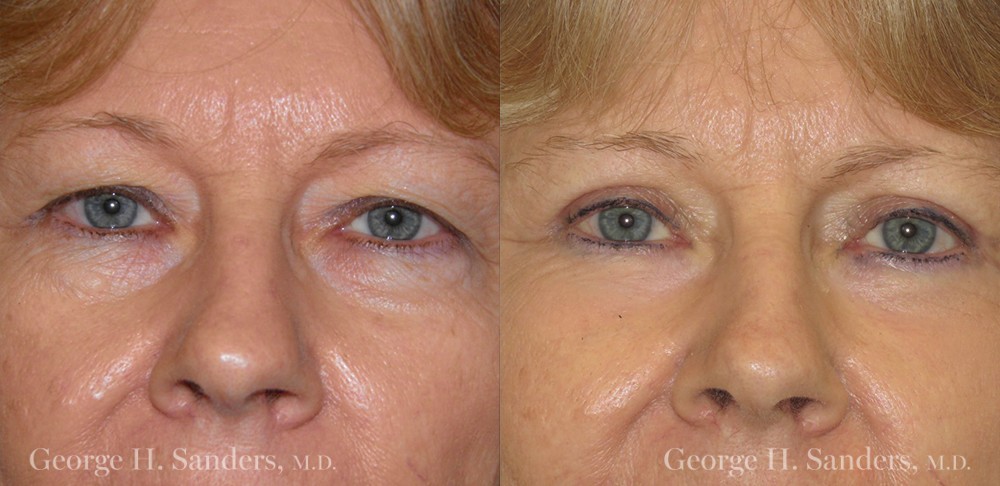 Patient 5a Laserbrasion Before and After