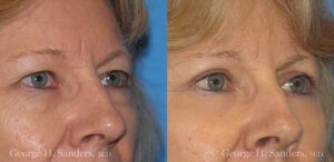 Patient 5b Laserbrasion Before and After