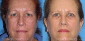Patient 6a Laserbrasion Before and After